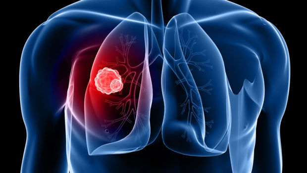 Czy w 2019 roku nastąpi przełom w diagnozowaniu raka płuca?