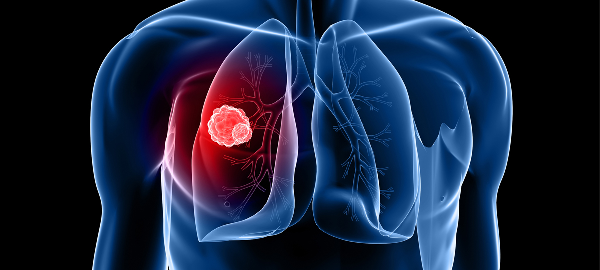 Czy w 2019 roku nastąpi przełom w diagnozowaniu raka płuca?