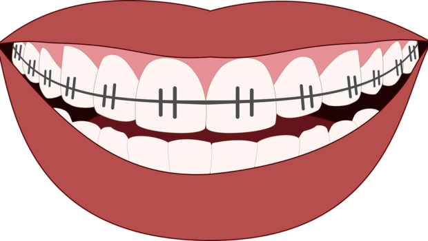 Aparat ortodontyczny – moda czy potrzeba?