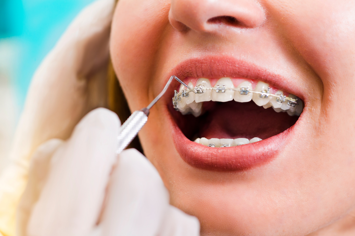 Na krzywy… zgryz Polaka. Dlaczego nie doceniamy leczenia ortodontycznego?
